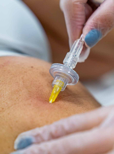 Carboxiterapia en manizales